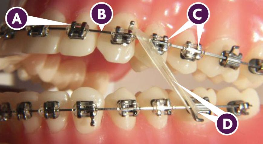 ставят ли брекеты если нет одного зуба